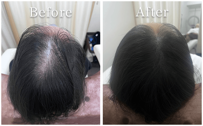 アートメイク症例1