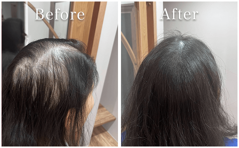 アートメイク症例2